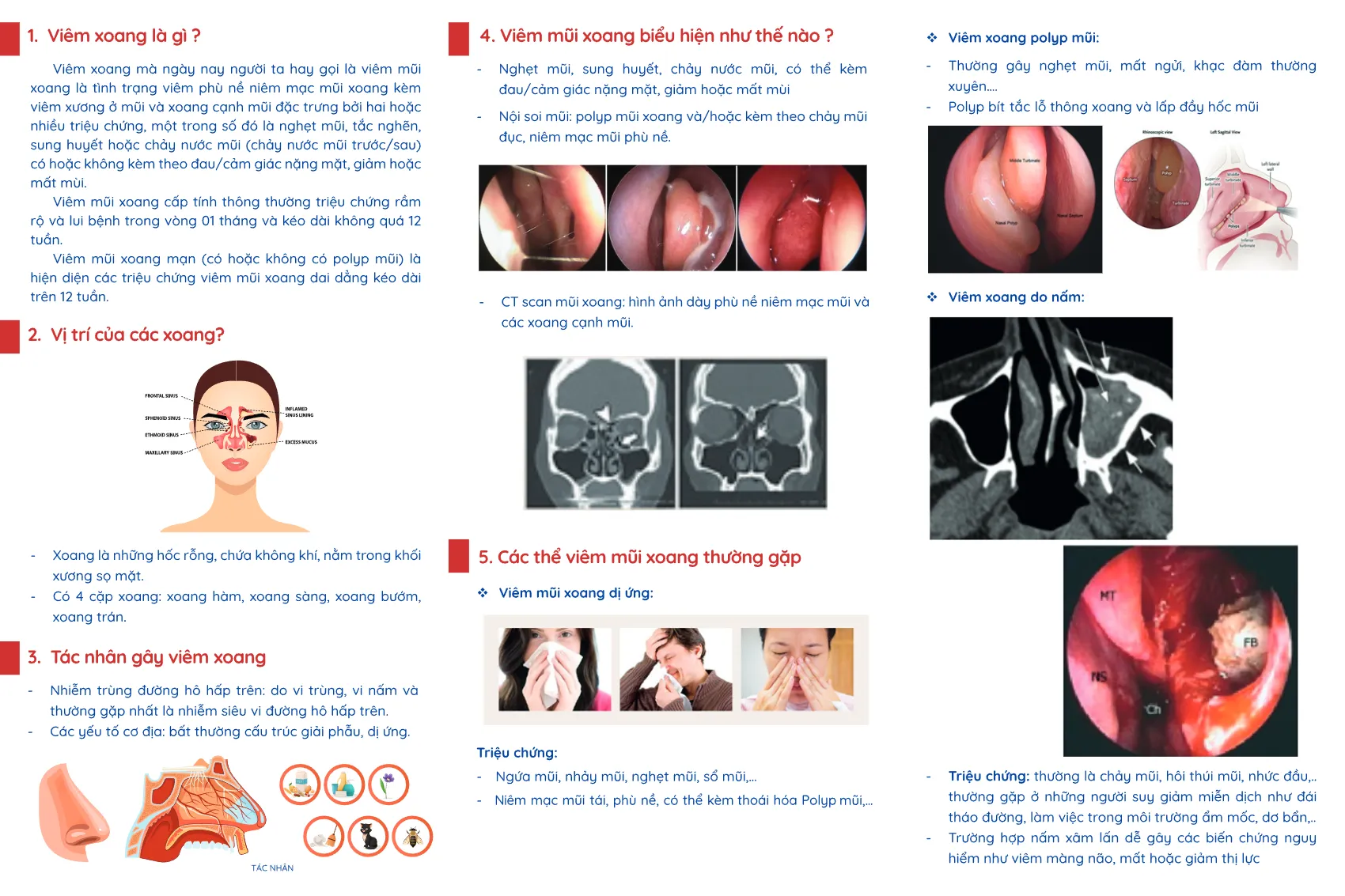 to roi viem mui xoang va nhung dieu can biet_2.webp